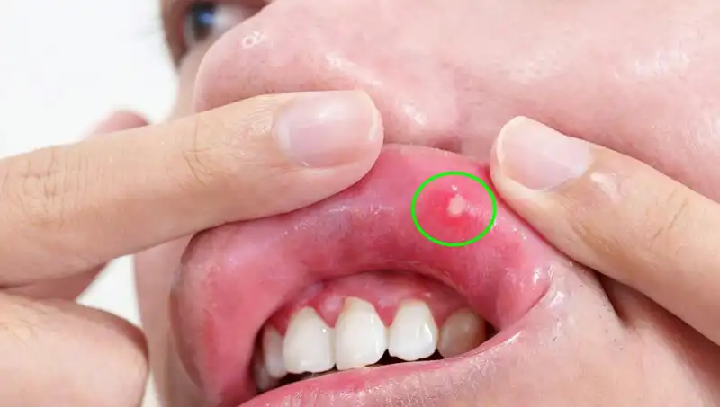 Dilindeki Belirtileri Görmezden Gelen Adamın Kanserle Sınavı