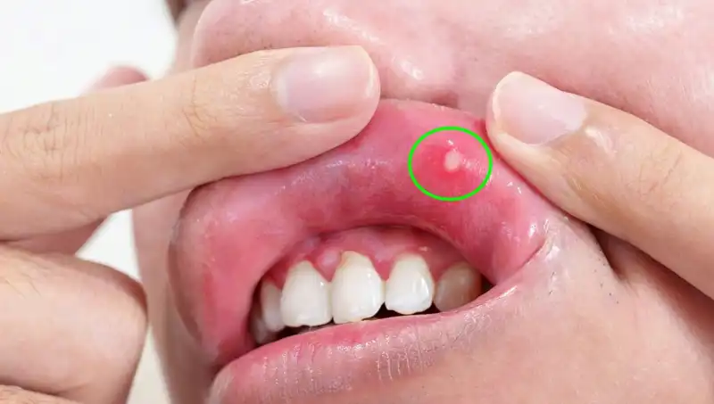 Vücudun İhtiyacı: B Vitamini Eksikliğinin Belirgin Belirtileri Neler?